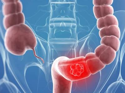 Causas aumento cáncer colorrectal menores de 50 años sin conocerse