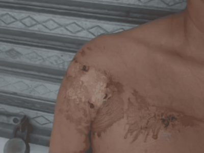 Mujer sufre quemaduras tras ataque con aceite caliente en Moca