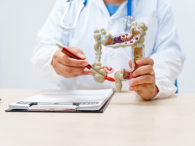 Cáncer de colon: seminario nacional sobre detección temprana