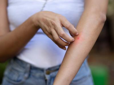 Conoce por qué los mosquitos pican más a unas personas que a otras